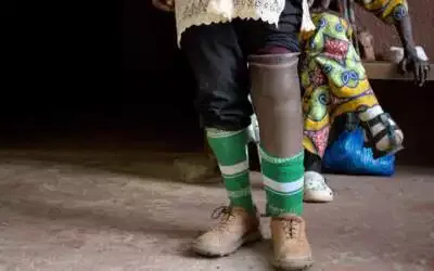 Le Sénégal favorise la prise en charge locale des invalidités liées à la lèpre